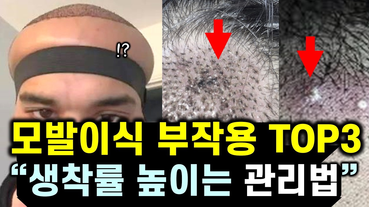  모발이식 부작용의 모든 것 & 예방법과 해결법 총정리 (탈모 모발이식 전 필수시청) - yongdr 썸네일