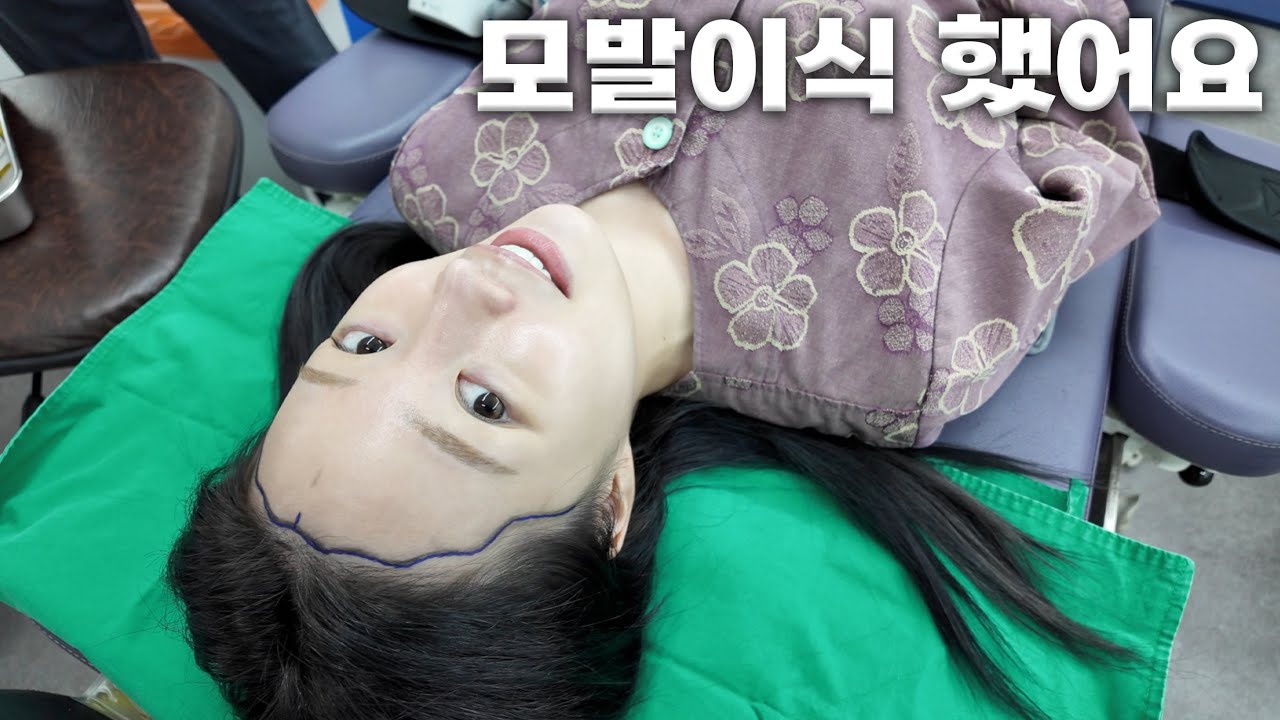  헤어라인 모발이식👼🏻 수술과정/한달차 후기📝 (M자 이마•여자 헤어라인•비절개•회복 과정)ㅣMINCARONG - mincarong 썸네일